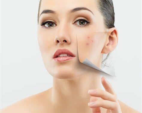Come trattare la pelle grassa a tendenza acneica