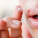 Herpes Labiale sintomi e cause