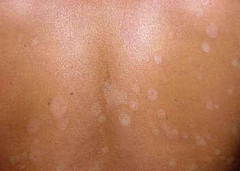 Fungo di mare o pitiriasi versicolor: prevenzione e cura