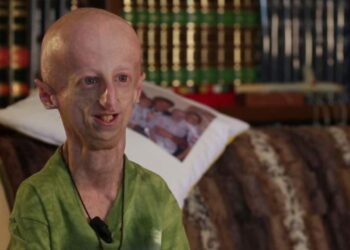 Progeria, Sammy Basso non avrebbe dovuto superare i 13 anni di vita