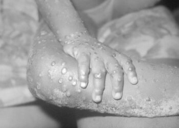 Vaiolo delle scimmie: ecco di cosa si tratta, prevenzione e cura