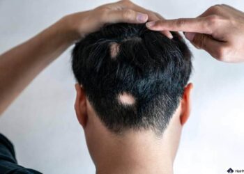 Alopecia, Fda approva nuovo farmaco che fa ricrescere i capelli