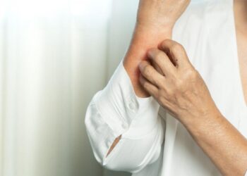 Covid, tra i sintomi di Omicron ci sono anche le eruzioni cutanee: cosa fare per gestirli al meglio