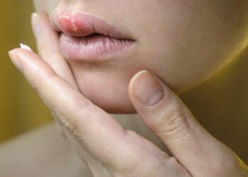 Herpes labiale: un virus «dormiente» risvegliato da sbalzi termici, stress e sole  