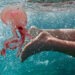 Punture di medusa, una disavventura estiva: cosa fare e cosa evitare