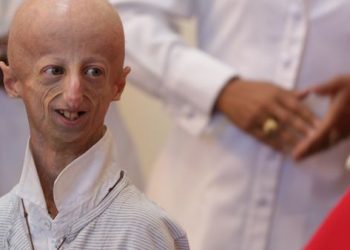 Morto Sammy Basso, colto da un malore al ristorante. Era il più longevo malato di Progeria